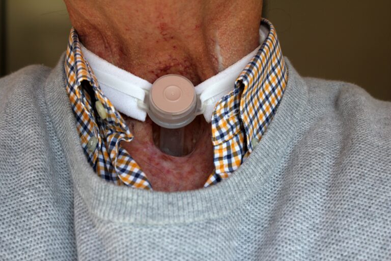 Tracheostomy Tube 